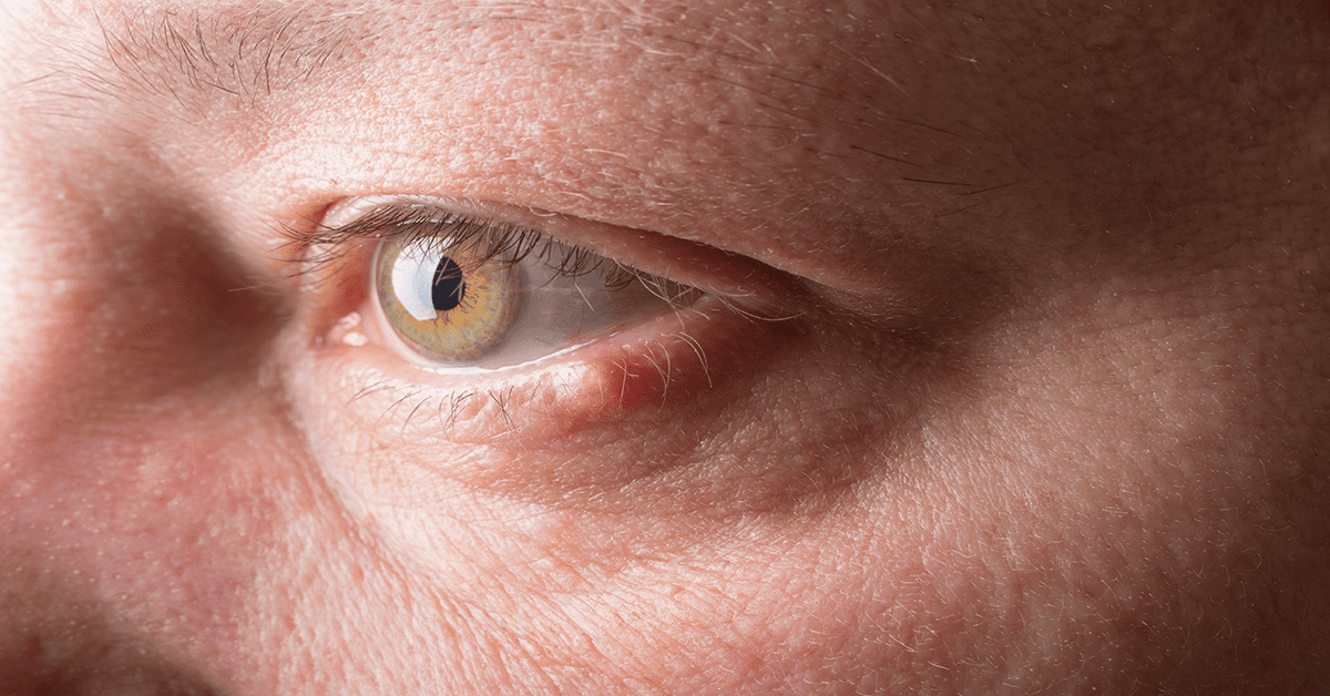 Ulcior la ochi cauze simptome și tratament Clinica Ofta Total