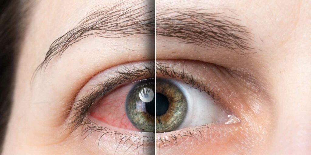 alergii la ochi, inainte si dupa tratament | Oftatotal
